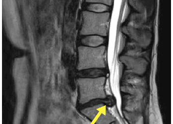 I Must Have Slipped A Disc!