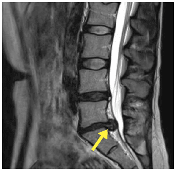 I Must Have Slipped A Disc!